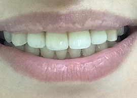 Full-Arch Immediate Restoration (Teeth-in-a-Day) after treatment