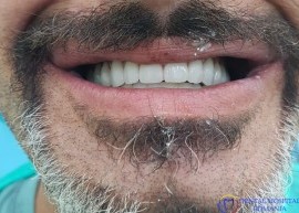Full-Mouth Surgical Rehabilitation after treatment