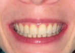 Advanced Clear Aligner Therapy after treatment