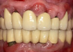 Advanced Periodontal & Gum Therapy after treatment